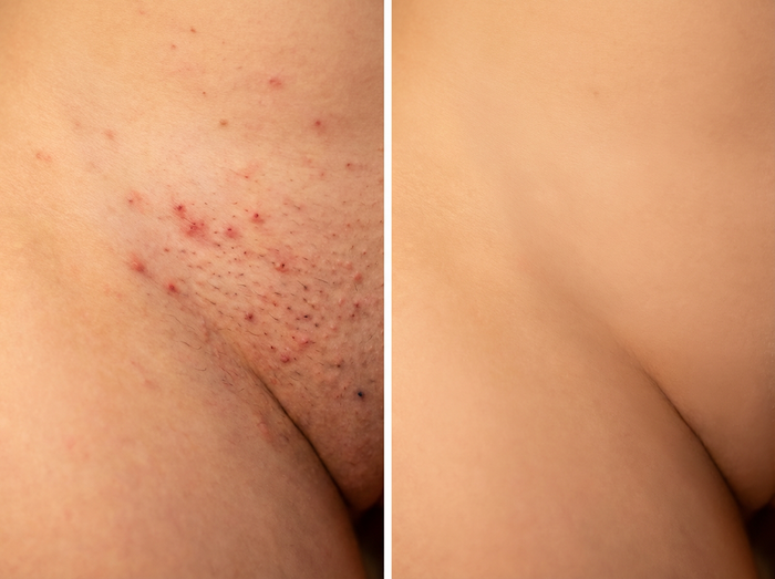 Vorher-Nachher Ergebnis